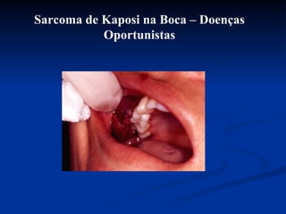 Sarcoma de Kaposi na Boca – Doenças Oportunistas 