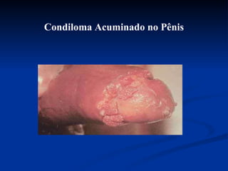 Condiloma Acuminado no Pênis 