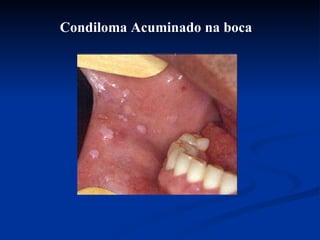 Condiloma Acuminado na boca 