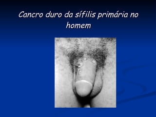   Cancro duro da sífilis primária no homem 
