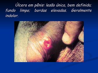 Úlcera em pênis: lesão única, bem definida; fundo limpo; bordas elevadas. Geralmente indolor. 