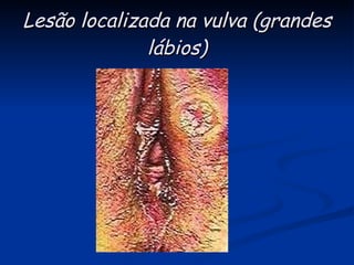 Lesão localizada na vulva (grandes lábios) 