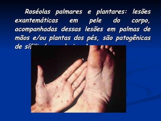 Roséolas palmares e plantares: lesões exantemáticas em pele do corpo, acompanhadas dessas lesões em palmas de mãos e/ou plantas dos pés, são patogênicas de sífilis (secundarismo). 