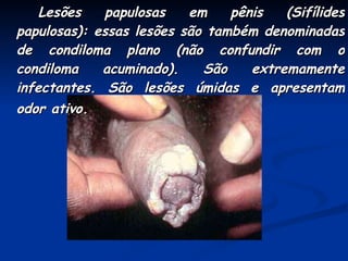 Lesões papulosas em pênis (Sifílides papulosas): essas lesões são também denominadas de condiloma plano (não confundir com o condiloma acuminado). São extremamente infectantes. São lesões úmidas e apresentam odor ativo.   