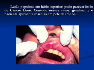 Lesão papulosa em lábio superior: pode parecer lesão de Cancro Duro. Contudo nesses casos, geralmente o paciente apresenta roséolas em pele de tronco. 