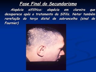 Fase Final do Secundarismo Alopécia sifilítica: alopécia em clareira que desaparece após o tratamento da Sífilis. Notar também rarefação do terço distal de sobrancelha (sinal de Fournier) 