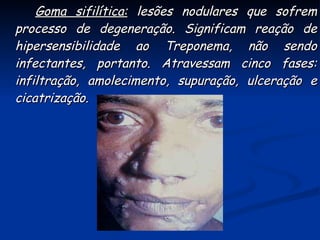 Goma sifilítica:  lesões nodulares que sofrem processo de degeneração. Significam reação de hipersensibilidade ao Treponema, não sendo infectantes, portanto. Atravessam cinco fases: infiltração, amolecimento, supuração, ulceração e cicatrização.  