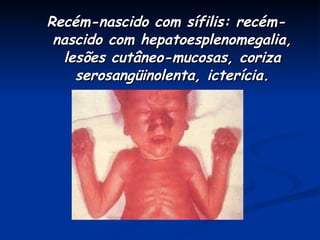 Recém-nascido com sífilis: recém-nascido com hepatoesplenomegalia, lesões cutâneo-mucosas, coriza serosangüinolenta, icterícia. 