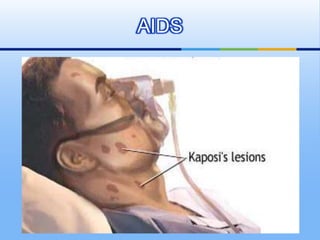 AIDS
 