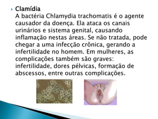  Clamídia
A bactéria Chlamydia trachomatis é o agente
causador da doença. Ela ataca os canais
urinários e sistema genital, causando
inflamação nestas áreas. Se não tratada, pode
chegar a uma infecção crônica, gerando a
infertilidade no homem. Em mulheres, as
complicações também são graves:
infertilidade, dores pélvicas, formação de
abscessos, entre outras complicações.
 