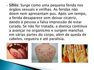  Sífilis: Surge como uma pequena ferida nos
órgãos sexuais e virilhas. As feridas não
doem nem apresentam pus. Após um tempo,
a ferida desaparece sem deixar cicatriz,
dando à pessoa a falsa impressão de estar
curada. Se não for tratada, a doença continua
a avançar no organismo e surgem manchas
em várias partes do corpo, além de queda de
cabelos, cegueira e até paralisia.
 