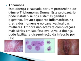  Tricomona
Esta doença é causada por um protozoário do
gênero Trichomonas Donne. Este protozoário
pode instalar-se nos sistemas genital e
digestivo. Provoca quadros inflamatórios na
uretra dos homens e no canal vaginal das
mulheres. Embora não acarrete complicações
mais sérias em sua fase evolutiva, a doença
pode facilitar a disseminação da infecção por
HIV.
 