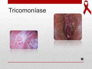 Tricomoníase
10
 