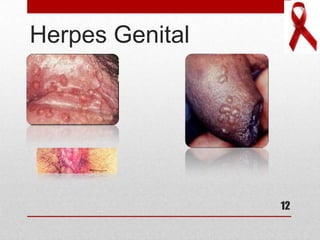 Herpes Genital
12
 
