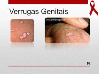 Verrugas Genitais
14
 