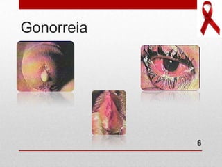 Gonorreia
6
 
