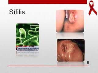 Sífilis
8
 