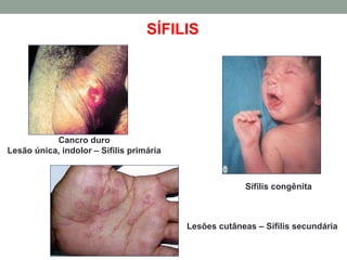 SÍFILIS
Cancro duro
Lesão única, indolor – Sífilis primária
Lesões cutâneas – Sífilis secundária
Sífilis congênita
 