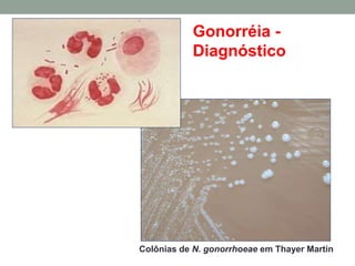 Colônias de N. gonorrhoeae em Thayer Martin
Gonorréia -
Diagnóstico
 