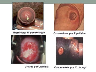 Uretrite por Clamídia Cancro mole, por H. ducreyi
Cancro duro, por T. pallidum
Uretrite por N. gonorrhoeae
 