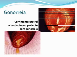 Gonorreia
Corrimento uretral
abundante em paciente
com gonorreia
 