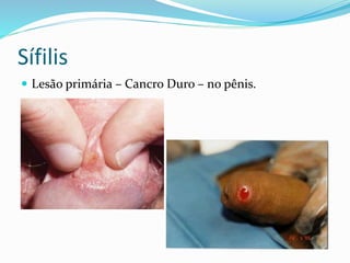 Sífilis
 Lesão primária – Cancro Duro – no pênis.
 