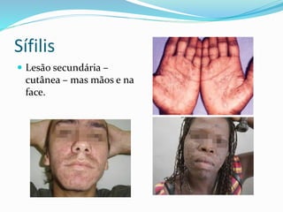 Sífilis
 Lesão secundária –
cutânea – mas mãos e na
face.
 