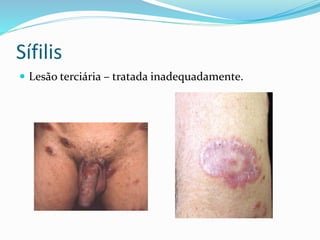 Sífilis
 Lesão terciária – tratada inadequadamente.
 