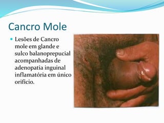 Cancro Mole
 Lesões de Cancro
mole em glande e
sulco balanoprepucial
acompanhadas de
adenopatia inguinal
inflamatória em único
orifício.
 