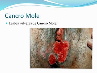 Cancro Mole
 Lesões vulvares de Cancro Mole.
 
