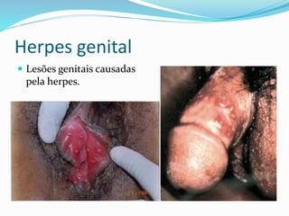 Herpes genital
 Lesões genitais causadas
pela herpes.
 