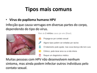 Tipos mais comuns
• Vírus do papiloma humano HPV
Infecção que causa verrugas em diversas partes do corpo,
dependendo do tipo do vírus.
Muitas pessoas com HPV não desenvolvem nenhum
sintoma, mas ainda podem infectar outros indivíduos pelo
contato sexual.
 