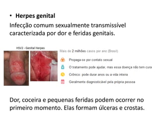 • Herpes genital
Infecção comum sexualmente transmissível
caracterizada por dor e feridas genitais.
Dor, coceira e pequenas feridas podem ocorrer no
primeiro momento. Elas formam úlceras e crostas.
 