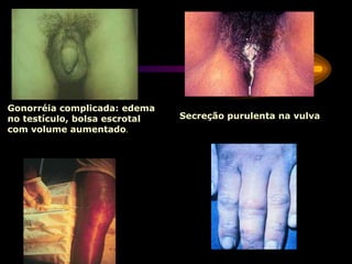 Gonorréia complicada: edema
no testículo, bolsa escrotal
com volume aumentado.
Secreção purulenta na vulva
 