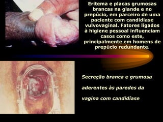Eritema e placas grumosas
brancas na glande e no
prepúcio, em parceiro de uma
paciente com candidíase
vulvovaginal. Fatores ligados
à higiene pessoal influenciam
casos como este,
principalmente em homens de
prepúcio redundante.
Secreção branca e grumosa
aderentes às paredes da
vagina com candidíase.
 