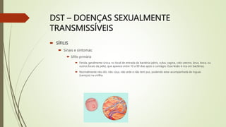 DST – DOENÇAS SEXUALMENTE
TRANSMISSÍVEIS
 SÍFILIS
 Sinais e sintomas:
 Sífilis primária
 Ferida, geralmente única, no local de entrada da bactéria (pênis, vulva, vagina, colo uterino, ânus, boca, ou
outros locais da pele), que aparece entre 10 a 90 dias após o contágio. Essa lesão é rica em bactérias.
 Normalmente não dói, não coça, não arde e não tem pus, podendo estar acompanhada de ínguas
(caroços) na virilha.
 
