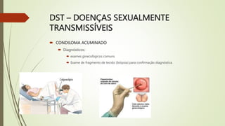 DST – DOENÇAS SEXUALMENTE
TRANSMISSÍVEIS
 CONDILOMA ACUMINADO
 Diagnósticos:
 exames ginecológicos comuns
 Exame de fragmento de tecido (biópsia) para confirmação diagnóstica.
 