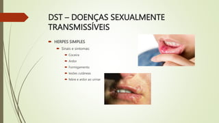DST – DOENÇAS SEXUALMENTE
TRANSMISSÍVEIS
 HERPES SIMPLES
 Sinais e sintomas:
 Coceira
 Ardor
 Formigamento
 lesões cutâneas
 febre e ardor ao urinar
 