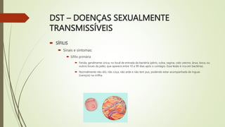DST – DOENÇAS SEXUALMENTE
TRANSMISSÍVEIS
 SÍFILIS
 Sinais e sintomas:
 Sífilis primária
 Ferida, geralmente única, no ...