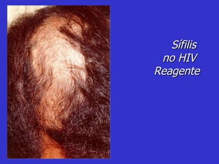 Sífilis  no HIV  Reagente 