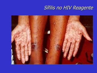 Sífilis no HIV Reagente 