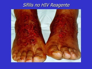 Sífilis no HIV Reagente 