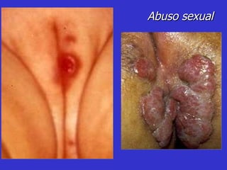 Abuso sexual 