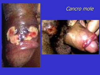 Cancro mole 