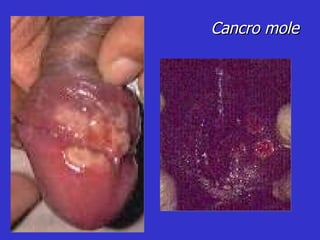 Cancro mole 