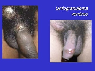 Linfogranuloma venéreo 