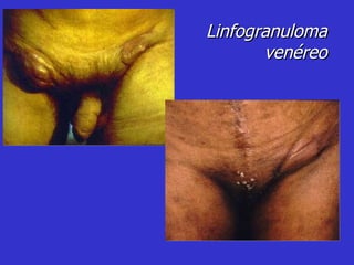 Linfogranuloma venéreo 