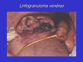 Linfogranuloma venéreo 