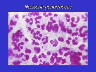 Neisseria gonorrhoeae 
