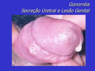 Gonorréia Secreção Uretral e Lesão Genital 